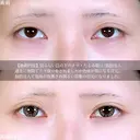 切らない目の下のたるみ取り/目の下・ゴルゴライン脂肪注入 before画像 サムネイル用