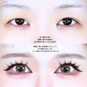 眼瞼下垂（たるみ取り併用） before画像 サムネイル用