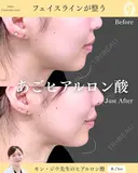 ヒアルロン酸注入（あご） 0日後 サムネイル用