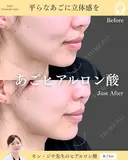 ヒアルロン酸注入（あご） before画像 サムネイル用