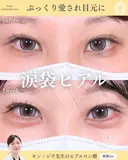 ヒアルロン酸注入（涙袋） 7日後 サムネイル用