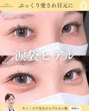 ヒアルロン酸注入（涙袋） before画像 サムネイル用
