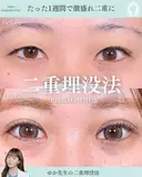 二重埋没法 7日後 サムネイル用
