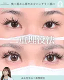 二重埋没法 30日後 サムネイル用