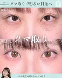 切らないクマ取り 180日後 サムネイル用