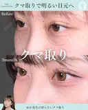 切らないクマ取り before画像 サムネイル用