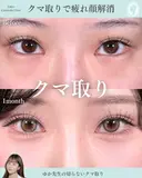切らないクマ取り 30日後 サムネイル用