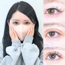 目頭切開/目尻切開/アリエルクイックループトリプル二重埋没法 90日後 サムネイル用