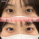 涙袋のヒアルロン酸注入（ボリフト） before画像 サムネイル用