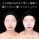 顎ヒアルロン酸/エラボトックス 90日後 サムネイル用