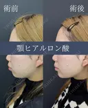 顎ヒアルロン酸(ボラックス) before画像 サムネイル用
