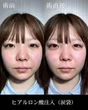 ヒアルロン酸注入（涙袋） after画像 サムネイル用