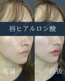 Cカールリップ(ボルベラ)　口角ボトックス(アラガン社製) after画像 サムネイル用