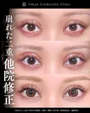 たるみ取り併用全切開法二重術/眼瞼下垂手術/埋没法抜糸/他院修正/MD式 90日後 サムネイル用