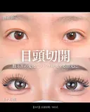 目頭切開/MD式 30日後 サムネイル用