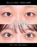 二重埋没法(韓国式自然癒着法6点) 7日後 サムネイル用