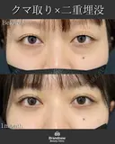 二重埋没＋脱脂＋脂肪注入（コンデンスリッチ） after画像 サムネイル用