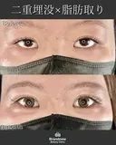 二重埋没＋上瞼の脂肪取り after画像 サムネイル用