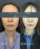 ルラリフト6本+ジョールファット除去 before画像 サムネイル用