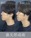 鼻尖形成術クローズ法 after画像 サムネイル用