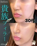 貴族フィラー before画像 サムネイル用