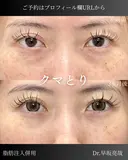 目の下のふくらみ取り・脂肪注入（目の下・ゴルゴライン） after画像 サムネイル用