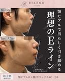 顎のヒアルロン酸 before画像 サムネイル用