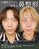 転生鼻尖形成（耳甲軟骨移植）＋小鼻縮小＋プロテーゼ＋鼻中隔延長 30日後 サムネイル用