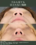 転生鼻尖形成（耳甲軟骨移植）＋小鼻縮小＋プロテーゼ＋鼻中隔延長 30日後 サムネイル用