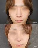転生鼻尖形成（耳甲軟骨移植）＋小鼻縮小＋プロテーゼ＋鼻中隔延長 7日後 サムネイル用