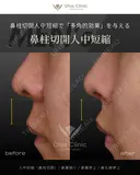 人中短縮（鼻柱切開）・鼻翼縮小・鼻翼挙上・鼻孔縁挙上  before画像 サムネイル用