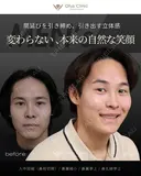 人中短縮（鼻柱切開）・鼻翼縮小・鼻翼挙上・鼻孔縁挙上  90日後 サムネイル用