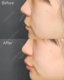 切らずに人中短縮👀！！人中短縮オリジオ＋人中ボトックス before画像 サムネイル用