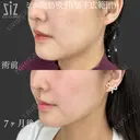 【ミニ脂肪吸引】頑張っても顎下だけ... before画像 サムネイル用