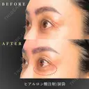 涙袋ヒアルロン酸 after画像 サムネイル用