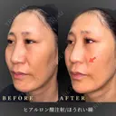 ヒアルロン酸注入術/ほうれい線 before画像 サムネイル用