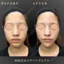 フェイスリフト/ヒアルロン酸注入 before画像 サムネイル用
