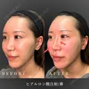 鼻ヒアルロン酸注入 before画像 サムネイル用