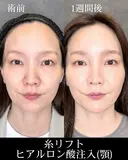 糸リフト/ヒアルロン酸注入(顎) before画像 サムネイル用