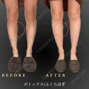ふくらはぎボトックス 60日後 サムネイル用