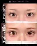 二重埋没法(クイックシンデレラ・トリプル)/埋没修正 before画像 サムネイル用