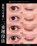 二重埋没法(クイックシンデレラ・トリプル)/埋没修正 30日後 サムネイル用