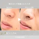 【形成外科専門医在籍】これで人中のお悩み解決🍀人中短縮セット✨ 30日後 サムネイル用