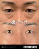Dr浦野執刀🌿切らない目の下のクマ取り before画像 サムネイル用