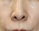 【40代女性・鼻の穴が見えるのが気になる】鼻孔縁下降術（1ヶ月後） before画像 サムネイル用
