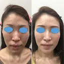 【女性】 ヒアルロン酸小顔カスタマイズ before画像 サムネイル用