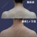 肩ボトックス 30日後 サムネイル用