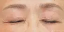 【60代女性・目の開きを改善】眼瞼下垂（埋没法）＋二重埋没法（マイクロメソッド＋α）（2ヶ月後） 30日後 サムネイル用