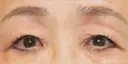 【60代女性・目の開きを改善】眼瞼下垂（埋没法）＋二重埋没法（マイクロメソッド＋α）（2ヶ月後） 30日後 サムネイル用