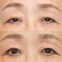 【60代女性・目の開きを改善】眼瞼下垂（埋没法）＋二重埋没法（マイクロメソッド＋α）（2ヶ月後） 30日後 サムネイル用